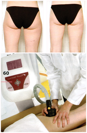 Lipomassage Lumicell touch Lipomassage Lumicell touch